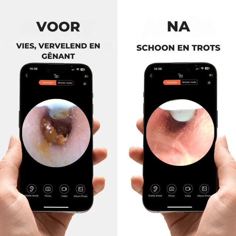OorZicht® Pro｜Professionele Oorenreiniger